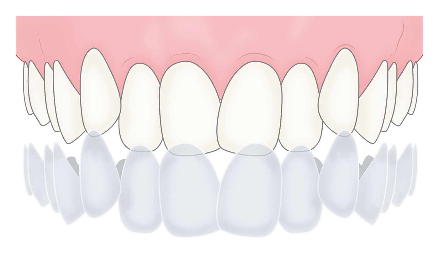 短期間のマウスピース矯正 前歯小臼歯のみ動かします 両顎２９万円 